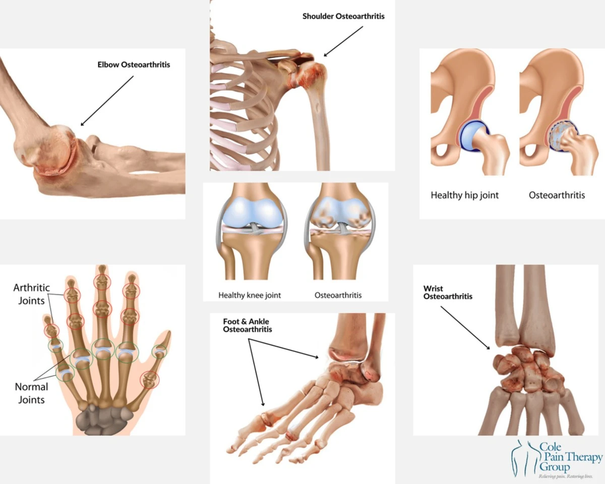 zastrzykktoryre-extra-1.webp Zastrzyk, który regeneruje stawy? Przełomowa metoda może wyeliminować ból bez operacji - image 1
