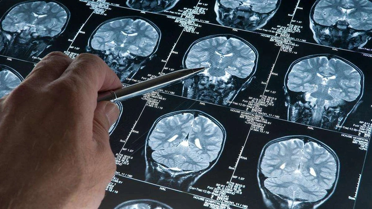 Dlaczego najdroższe leki na Alzheimera mogą nie przynosić realnej poprawy - image 1