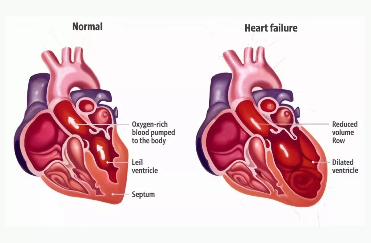 Leki na dnę moczanową mogą chronić serce: nowe odkrycia naukowców - image 1