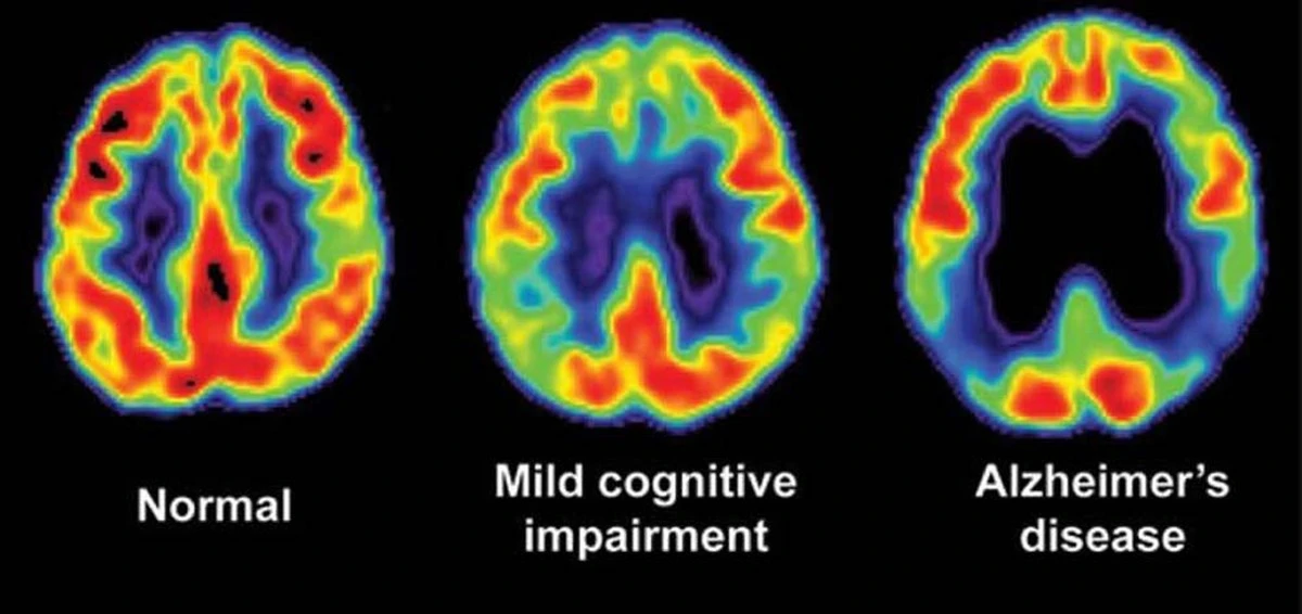 Choroba Alzheimera w rodzinie: czy test genetyczny i zmiana diety naprawdę mają sens? - image 1