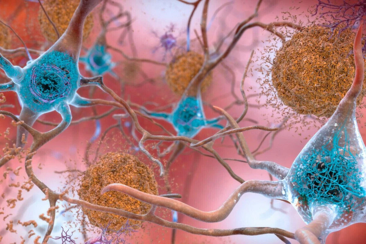 Dlaczego niektórzy mają zmiany w mózgu typowe dla Alzheimera, ale wciąż cieszą się pełną sprawnością