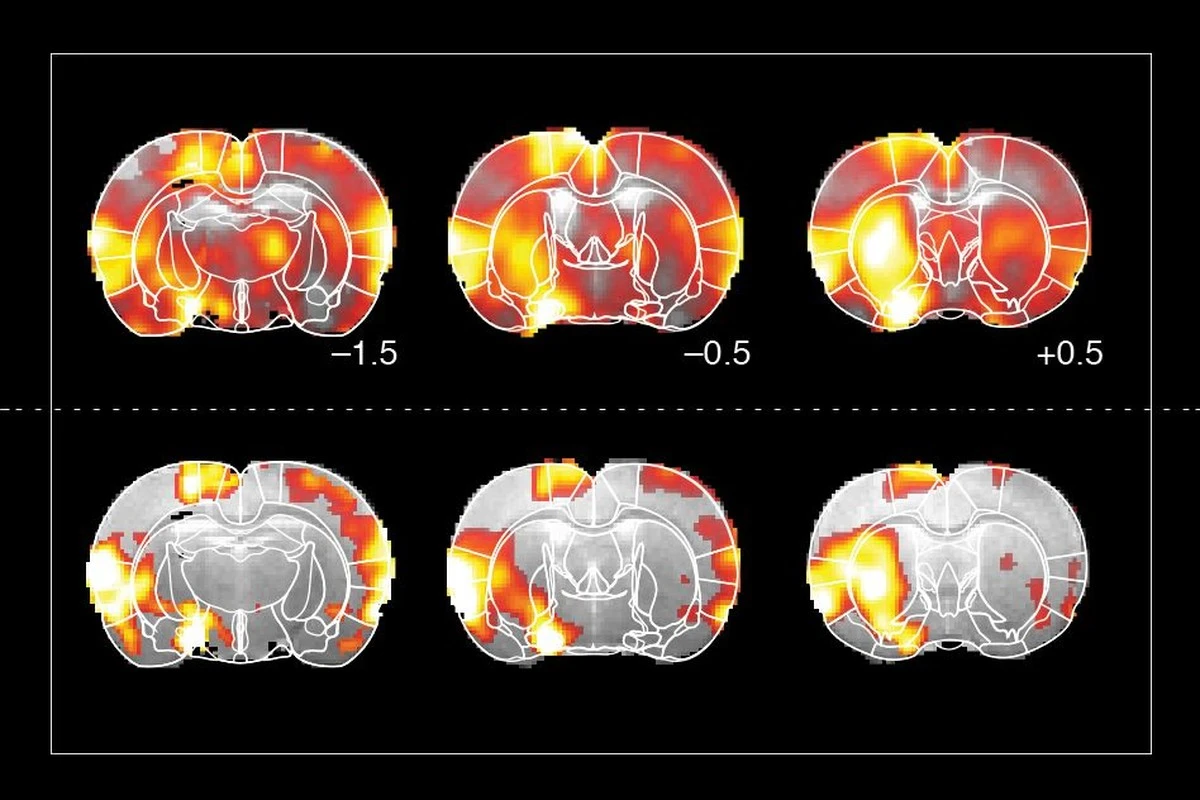 dlaczegolekarze-extra-1.webp Dlaczego lekarze badają teraz mózgi młodych osób z autyzmem pod kątem Parkinsona - image 1