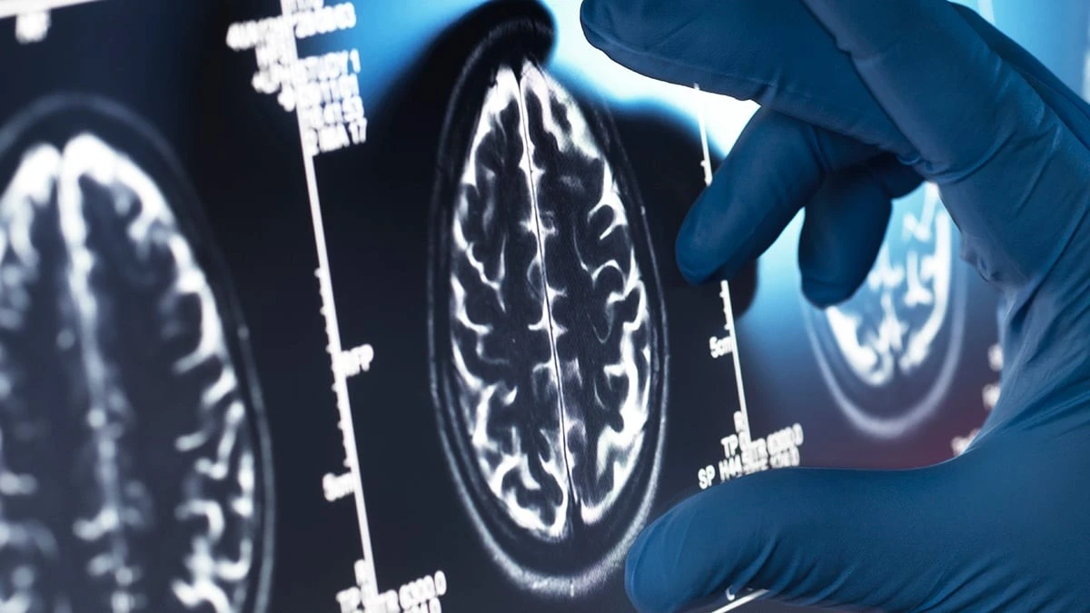 Dlaczego najdroższe leki na Alzheimera mogą nie przynosić realnej poprawy