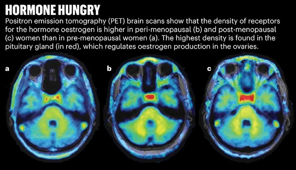 Dlaczego kobiety częściej chorują na Alzheimera: winne białko z choroby Parkinsona - image 1