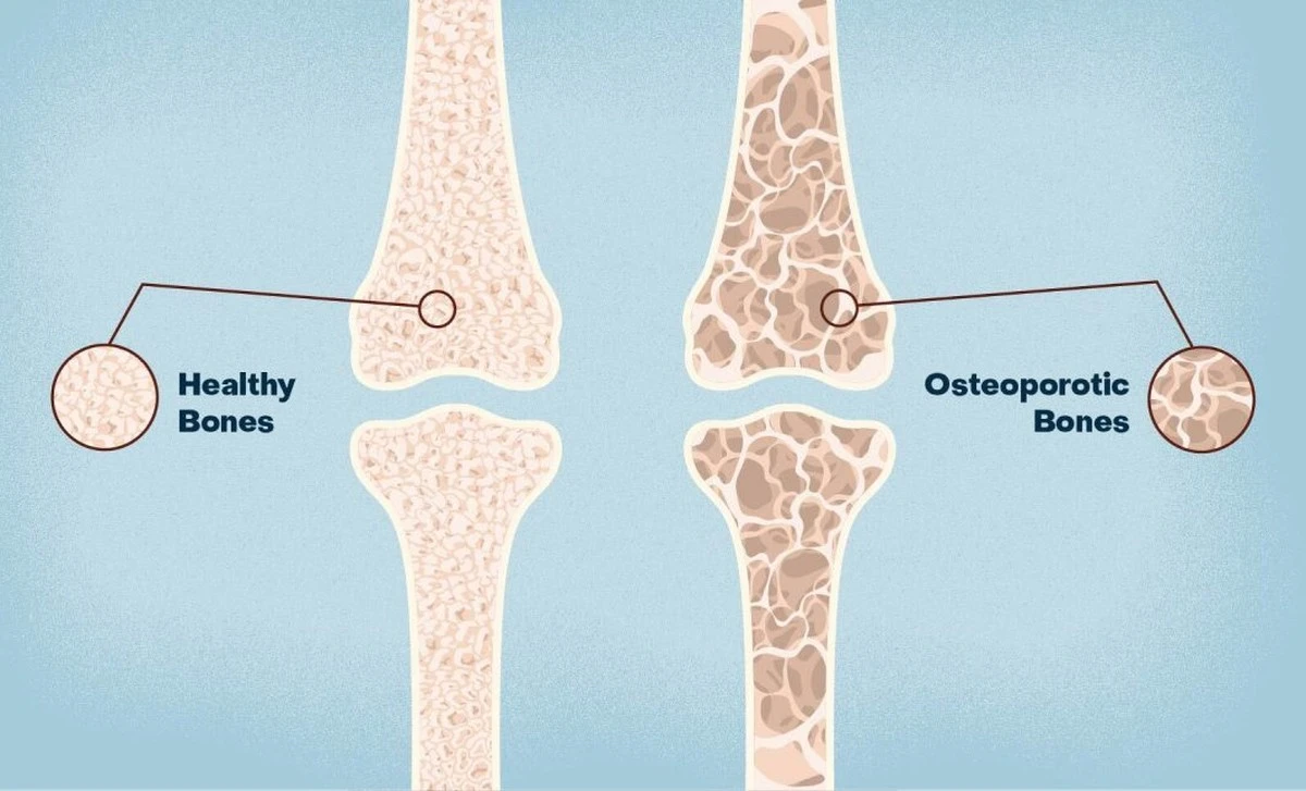 Osteopenia – cichy stan, który osłabia kości u 40% dorosłych - image 1
