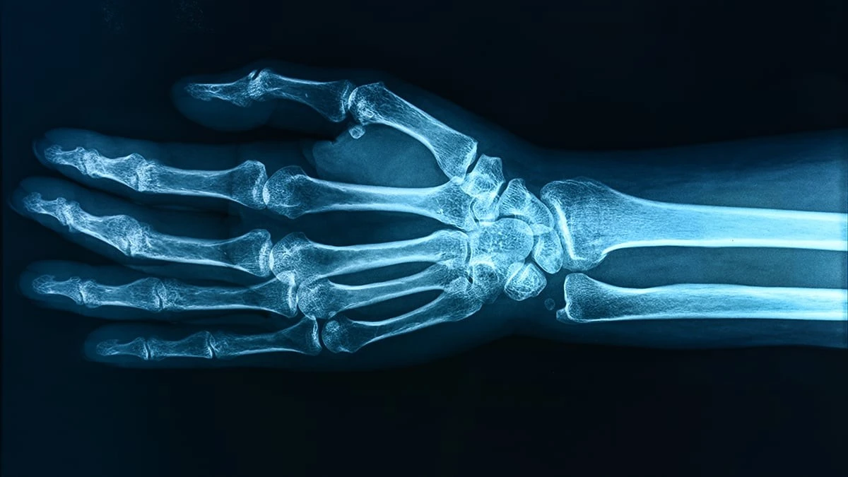 Dlaczego powszechne „wieczne chemikalia” mogą osłabiać kości twojego dziecka