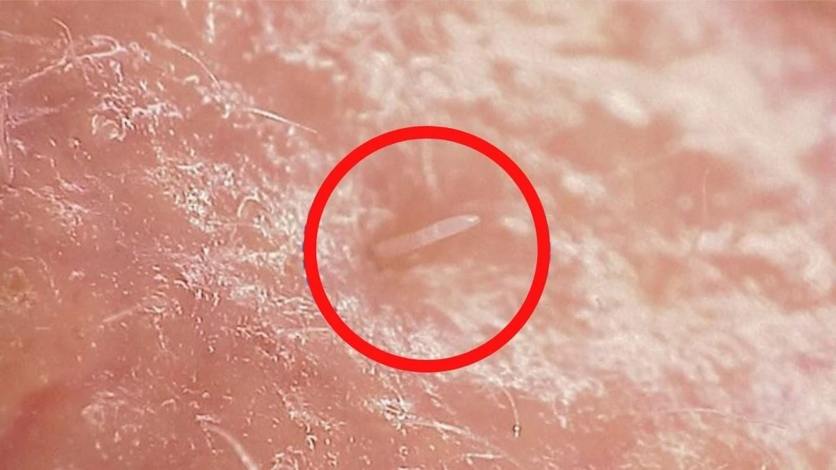 Twoje pory nie są puste: dlaczego mikroskopijne roztocza na stałe zamieszkały na twojej twarzy