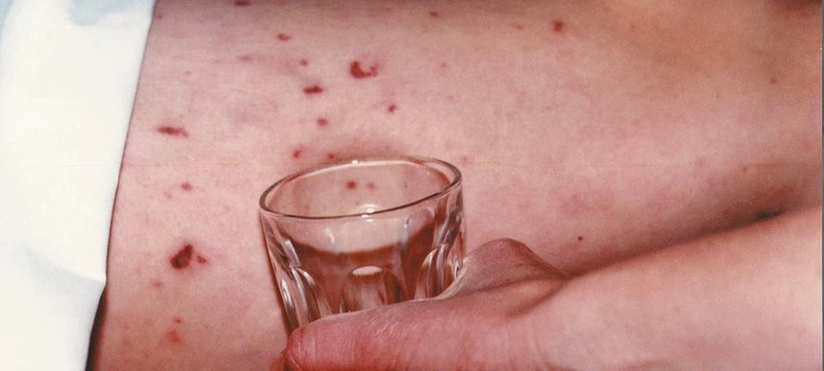 Dlaczego brytyjscy lekarze apelują do gości nocnych klubów: 27 przypadków poważnej infekcji - image 1