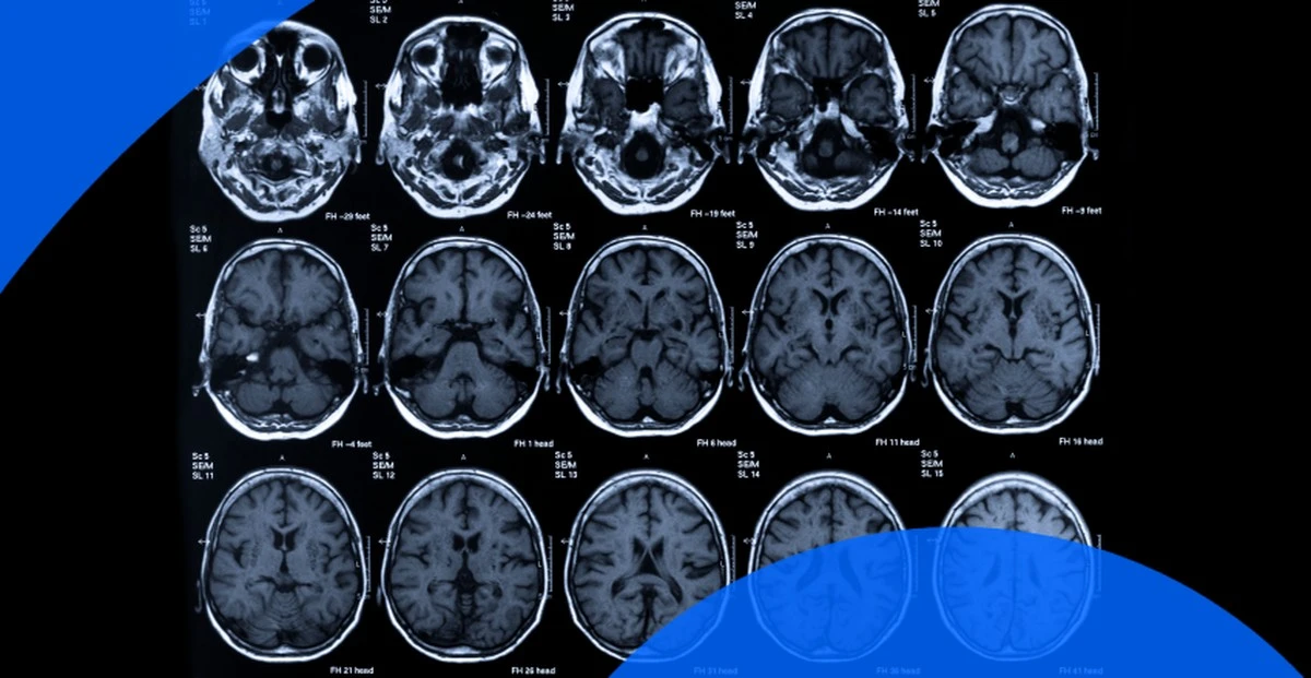 Szumy uszne a psychodeliki: nowa nadzieja w leczeniu tinnitusu - image 1