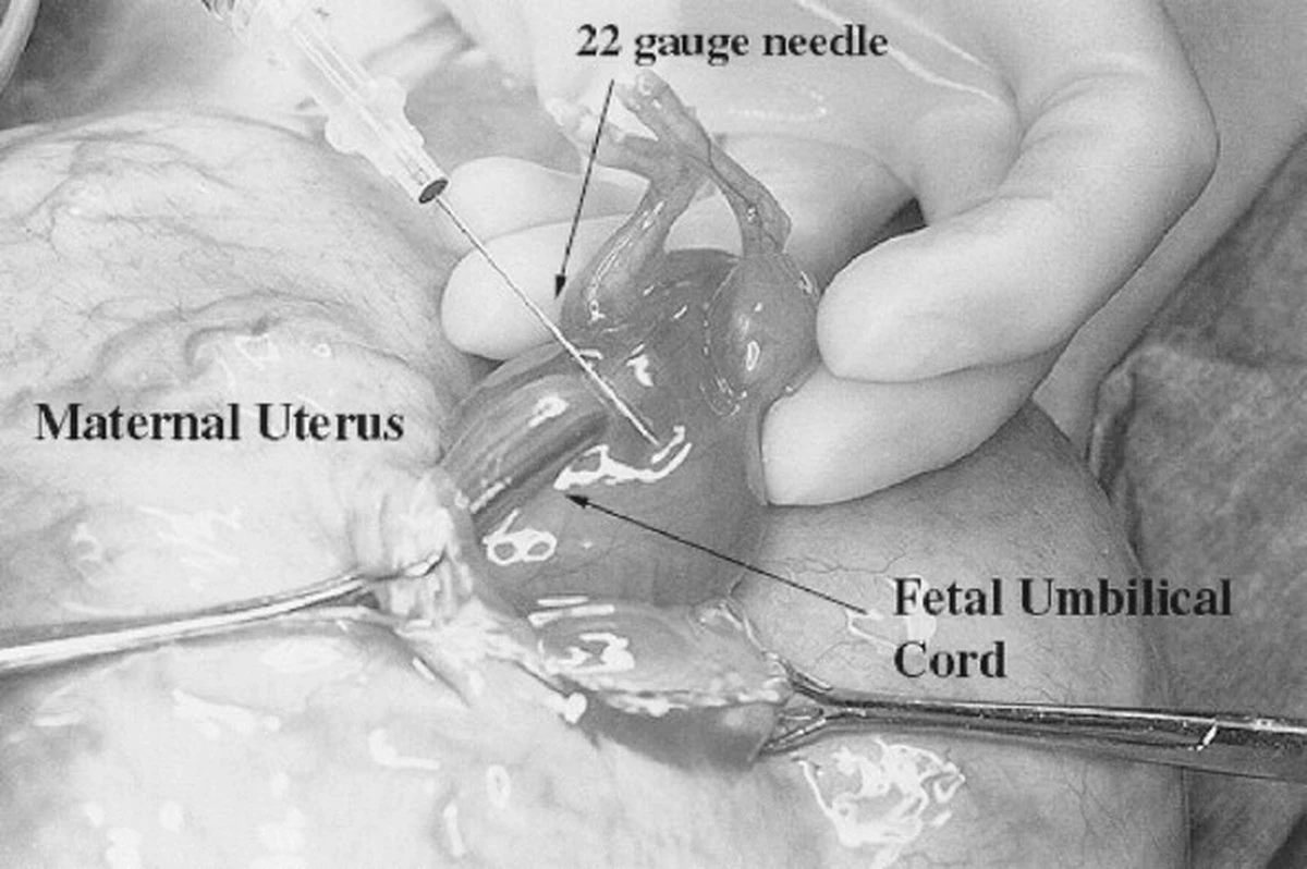 dlaczegolekarze-extra-1.webp Dlaczego lekarze nakładają „plastry” z łożyska na kręgosłupy nienarodzonych dzieci - image 1