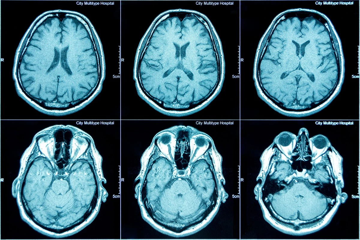 Co dzieje się w twoim mózgu, gdy ziewasz? Wyniki skanów MRI - image 1