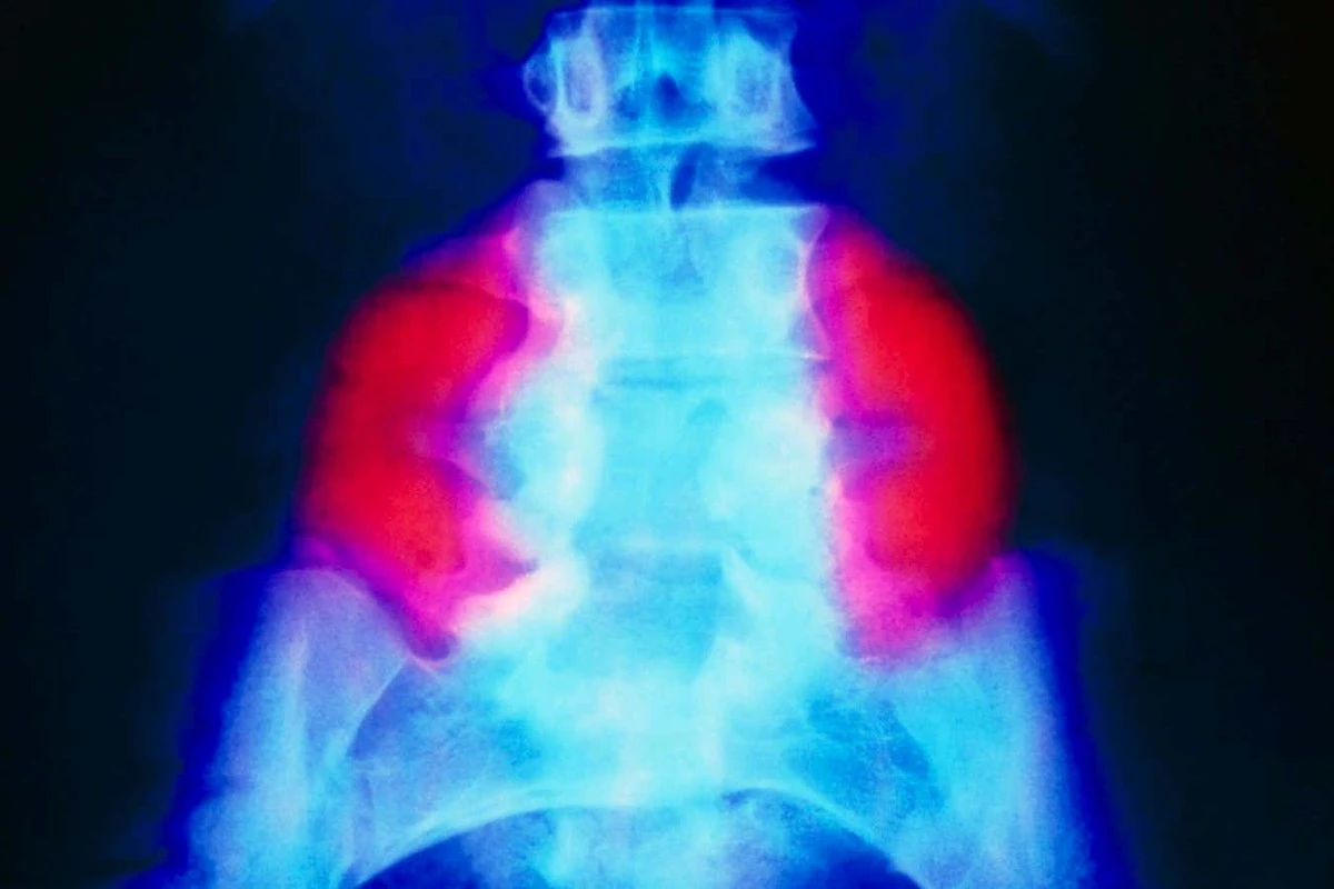 Dlaczego lekarze nakładają „plastry” z łożyska na kręgosłupy nienarodzonych dzieci