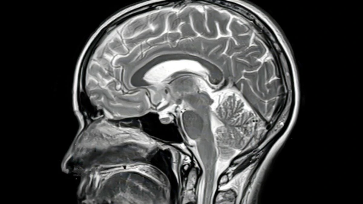 Dlaczego nowoczesne leki na Alzheimera nie działają? Rzadka autopsja odsłania lukę w terapii